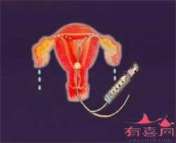 求北京正规助孕，北京医院买精子受孕多少钱